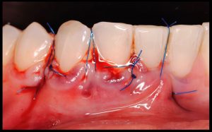 proceso tratamiento 5