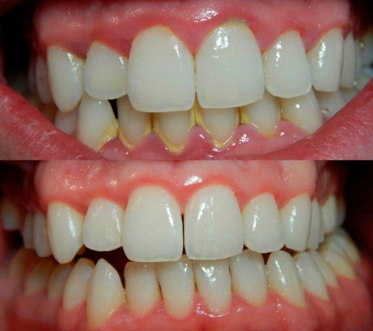 cuanto cuesta limpieza dental profesional