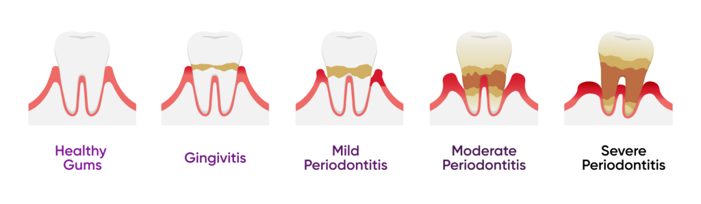 tipos de enfermedades periodentales