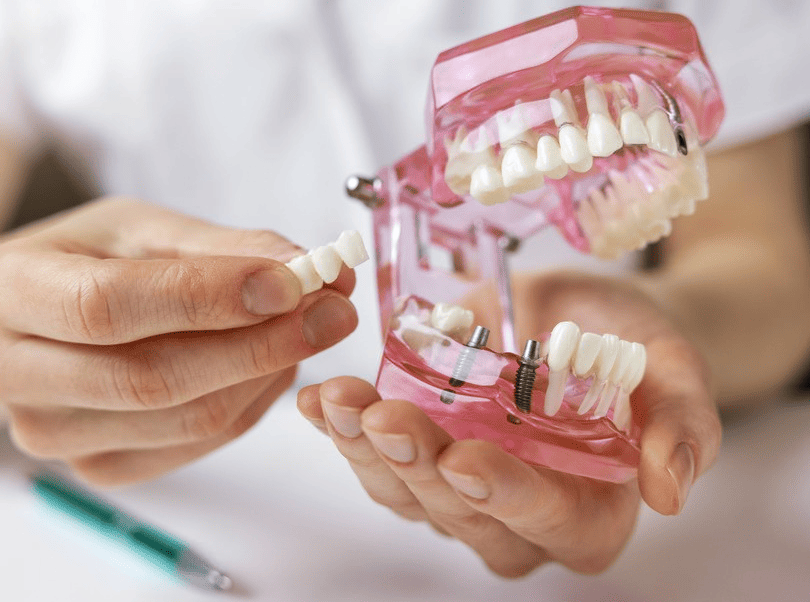 definicion importancia implantes dentales